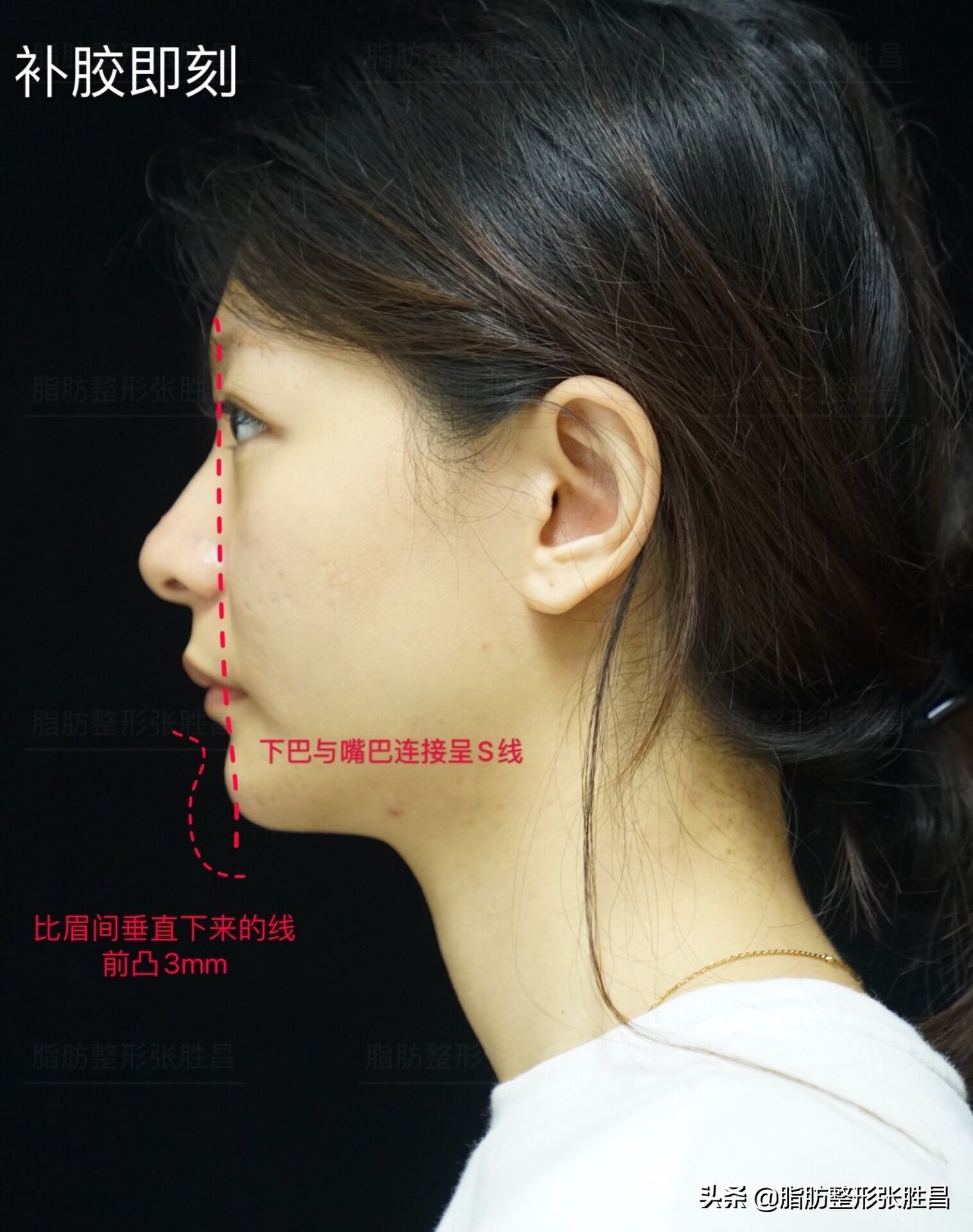 下巴缩短整容女,下巴短小北京