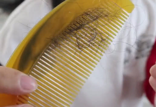 头上秃了一小块能治好吗,头上秃了一小块是什么原因还疼