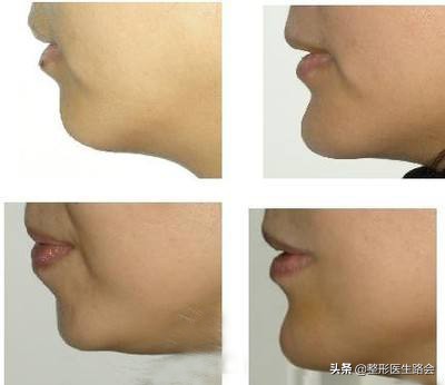 去除双下巴和颈部脂肪手术,手术去除下巴赘肉最有效的方法
