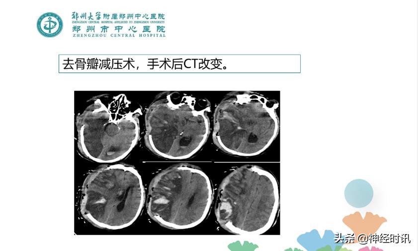 静脉溶栓怎么引起的,静脉相关并发症的预防及处理
