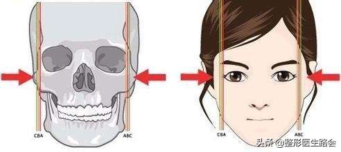 高颧骨下颌宽,颧骨高下颌骨宽上镜怎么办
