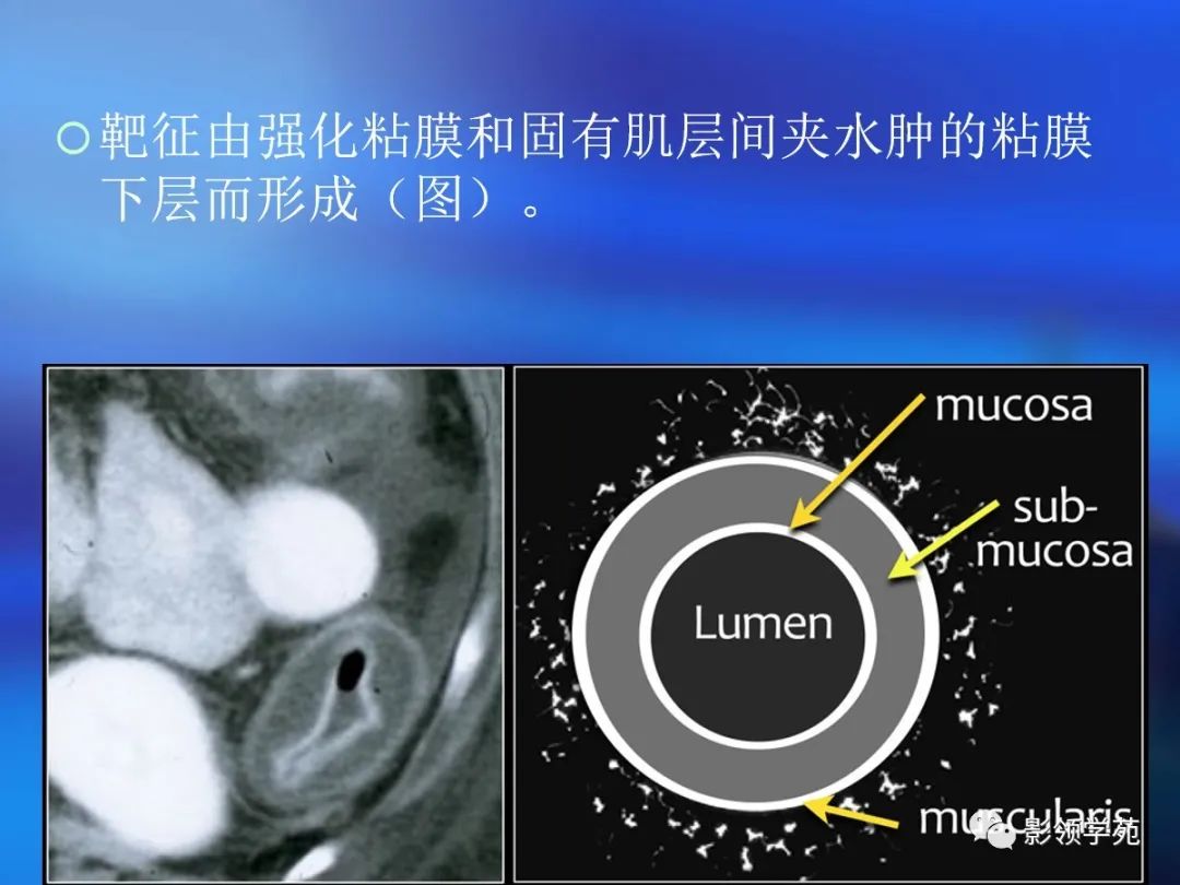 肠道内壁增厚,肠道扩张ct表现
