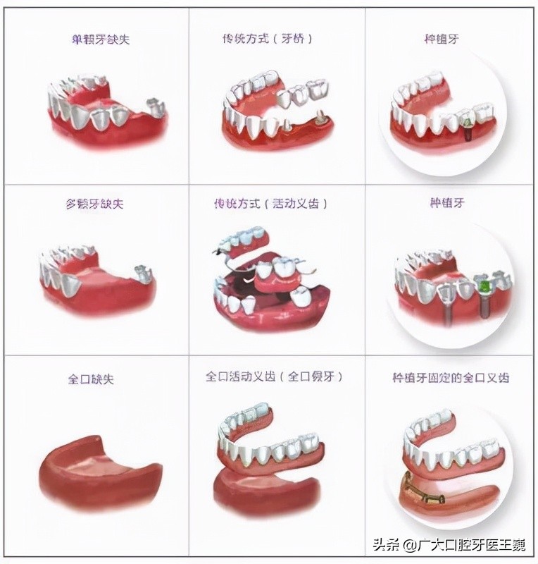 活动假牙戴长了对身体是否有害,活动假牙长期戴着对牙龈有影响吗