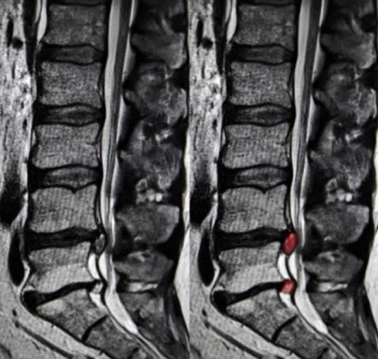 腰突的人怎样保健,腰突10天症状明显减轻可以运动么