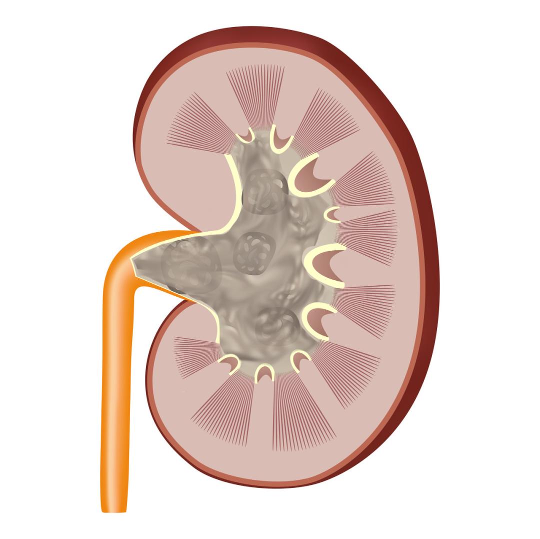 出现血尿尿完有点疼痛,尿尿好像有点堵有点刺痛肾结石