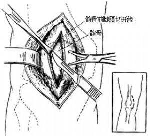 髌骨不舒服应该怎么锻炼,髌骨不肿可是疼怎么办