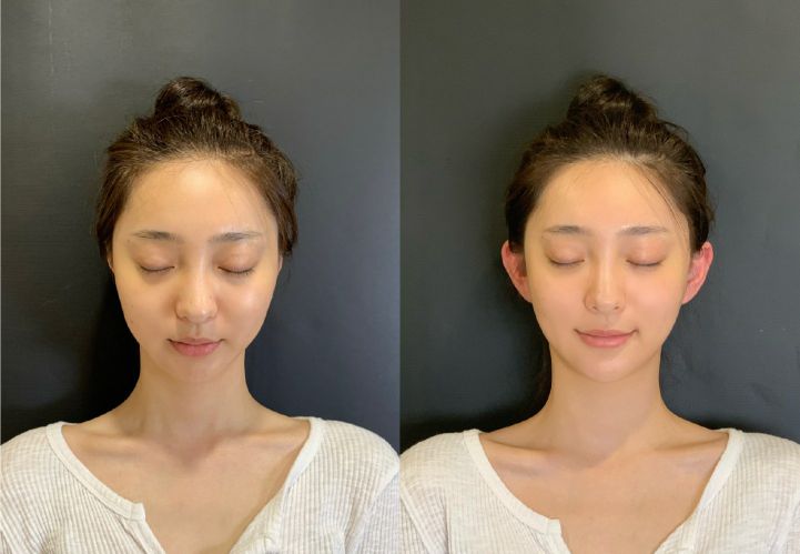 网红精灵耳为什么这么火,火爆全网的精灵耳究竟值得做吗