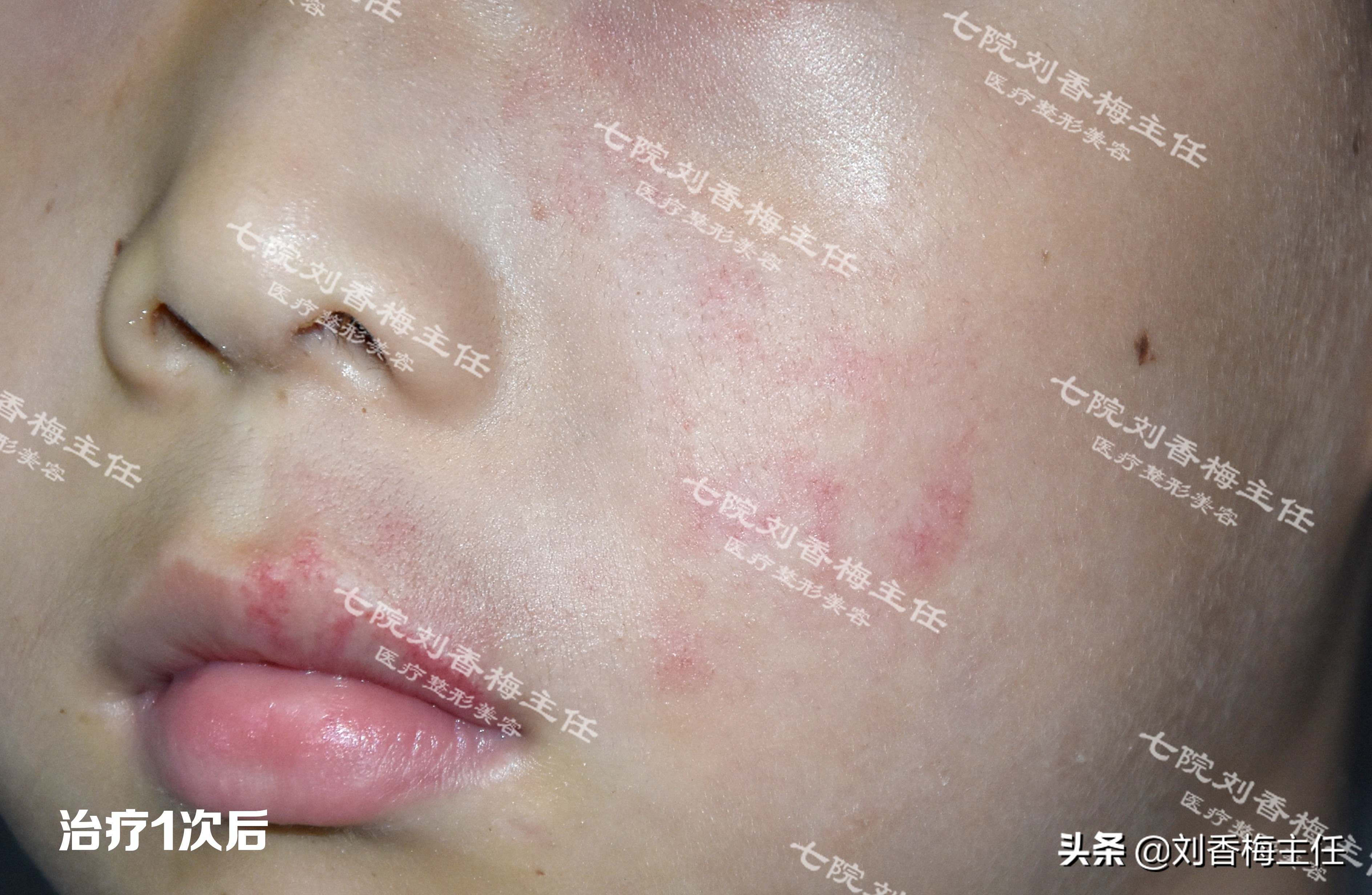 脉冲染料激光治疗鲜红斑痣治愈率,脉冲染料激光治鲜红斑痣效果