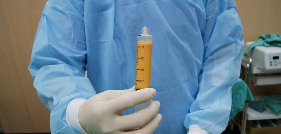 自体脂肪填充苹果肌凹陷,自体脂肪填充苹果肌太高了怎么办