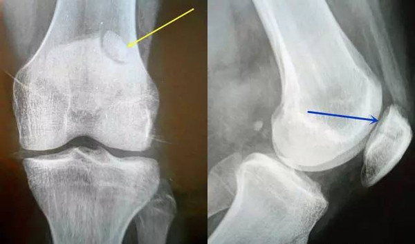膝盖痛髌骨上方有裂开要手术吗,膝盖髌骨后面突然像针扎一样疼