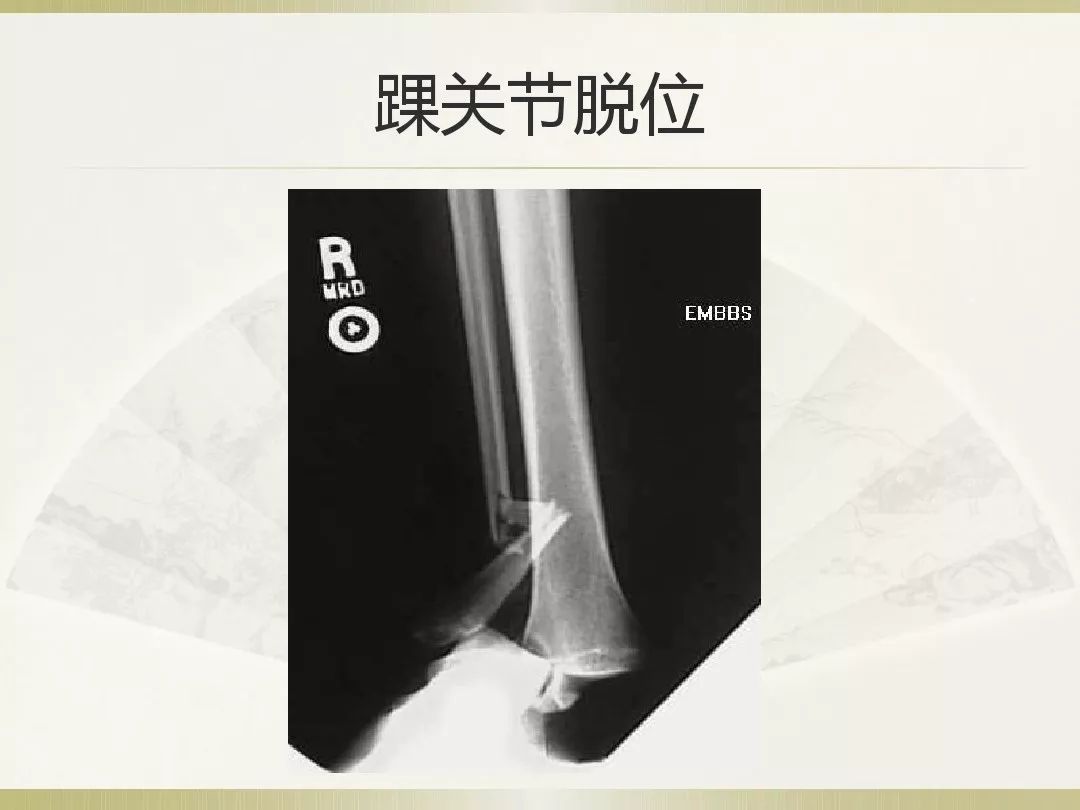 骨科x光片读片技巧,放射科骨科读片教程