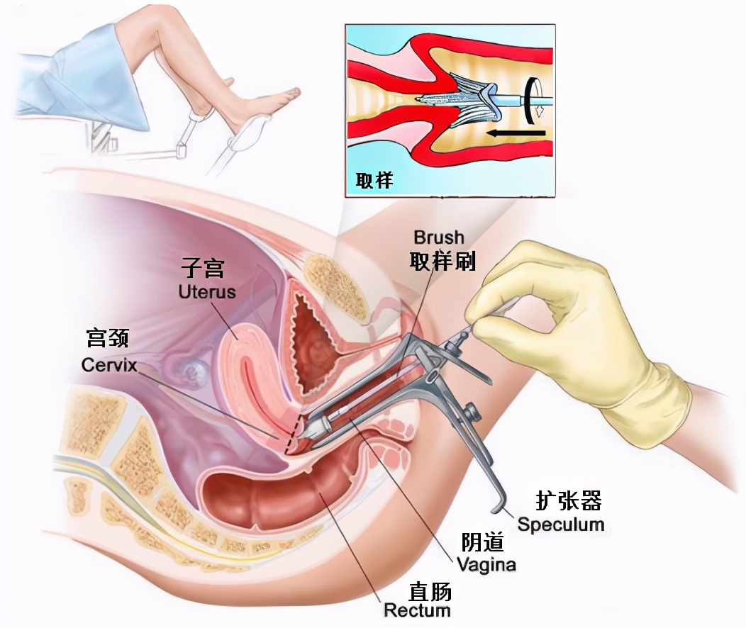 TCT、阴道镜、CIN、锥切(leep)都是什么意思?