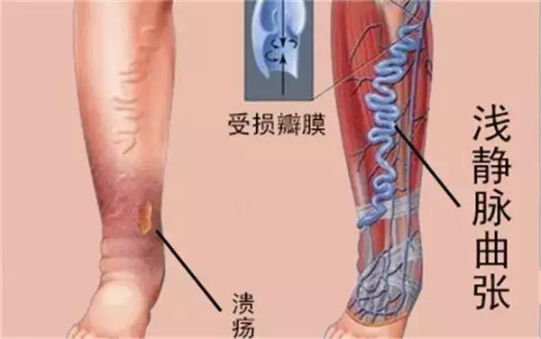 挤火疖子脓包有多痛,挤火疖子会往血管里爆吗