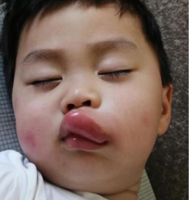 小孩上嘴唇突然肿成香肠嘴,小孩嘴巴突然肿大图片