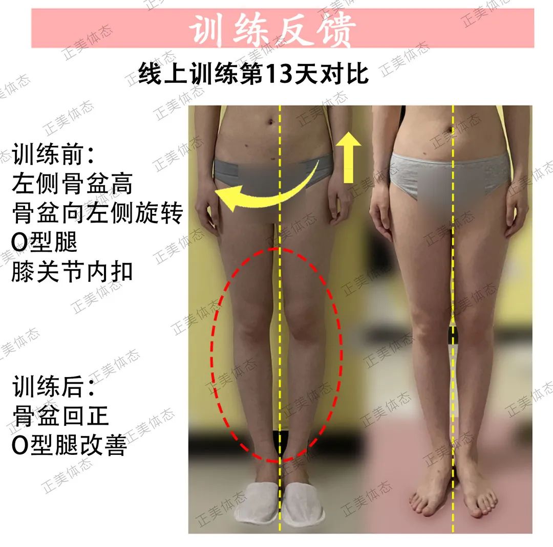 拯救腿型,o型腿睡觉姿势改善腿型