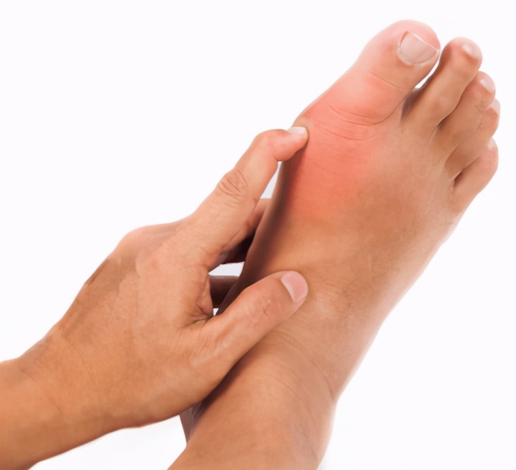 治疗痛风的中医外治法请按需收藏,西医治疗痛风的方法