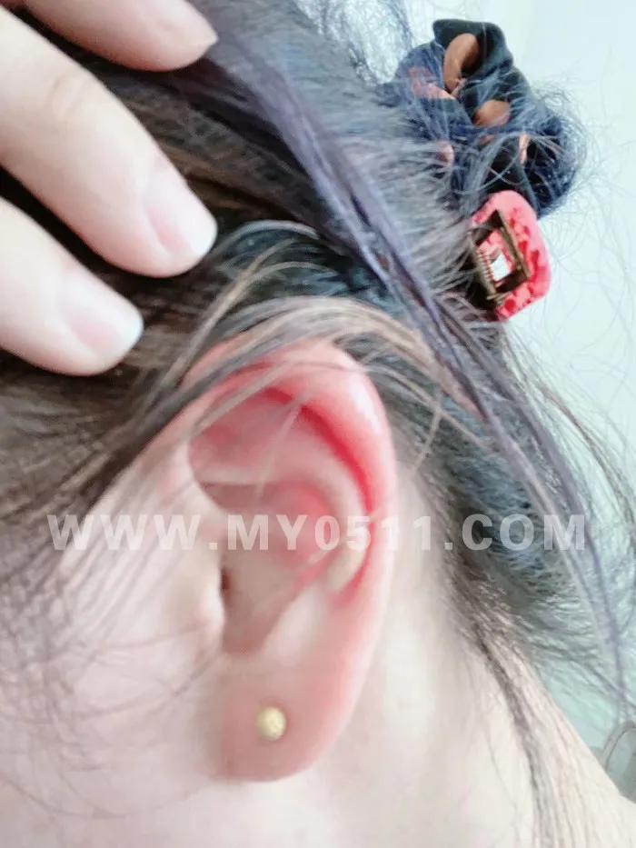 图片慎点！镇江网友打耳洞后发炎感染，耳骨被削，差点畸形