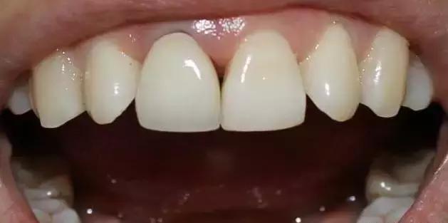 牙缝里为什么有褐色斑点,牙缝中间有黑的是怎么回事