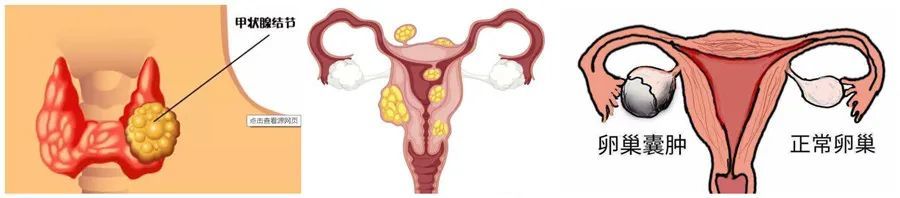 结节囊肿肌瘤包块用什么可以消除,囊肿结节切除