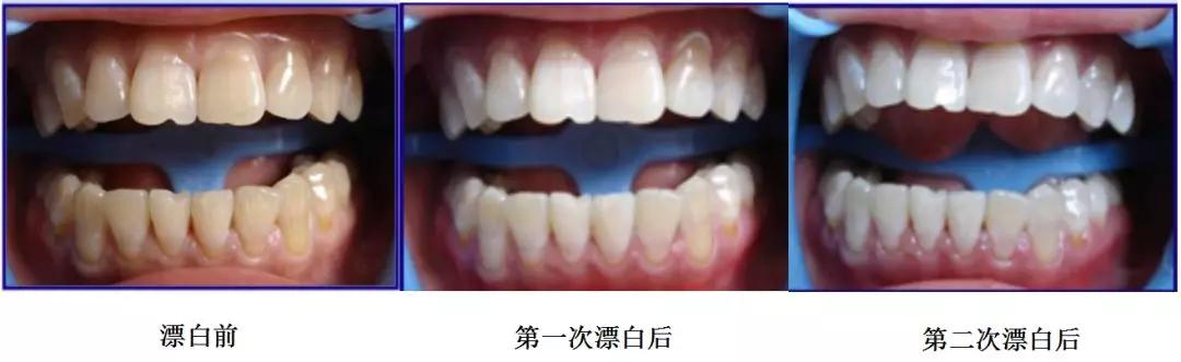 高露洁冷光牙齿美白仪怎么用,冷光美白牙齿一般用多长时间