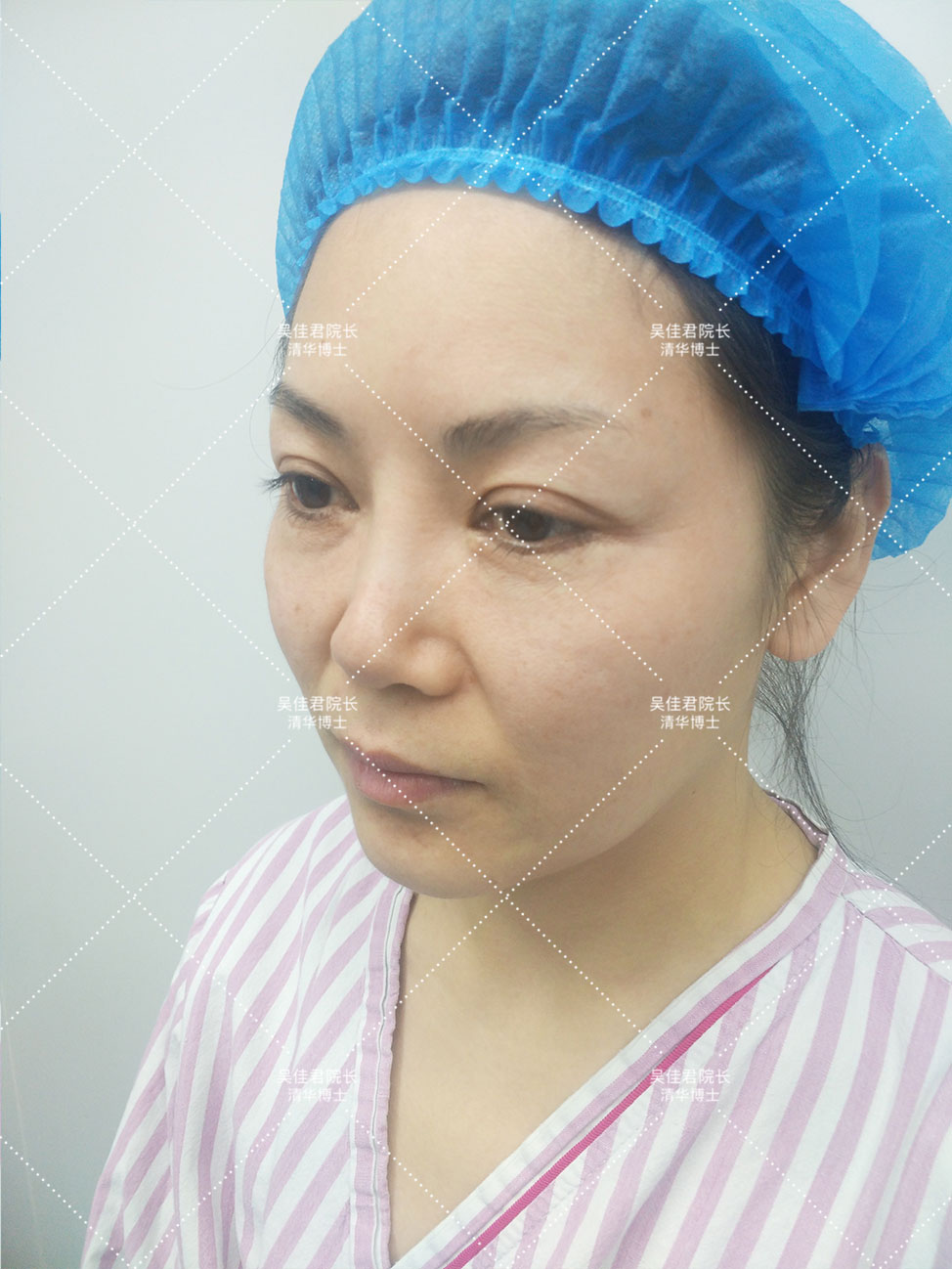 小拉皮术后恢复多久,小拉皮术后一个月发红