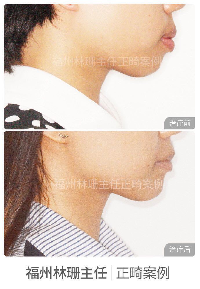 福州牙齿矫正林珊主任｜浅谈下颌后缩