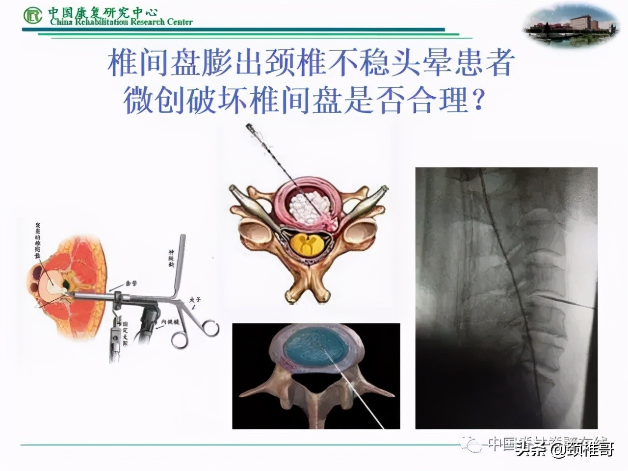 颈椎病的护理临床路径流程图,颈椎病的健康管理与康复指导