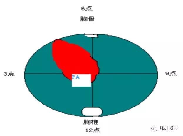 胎儿心脏三种血管关系模式图,25周的胎儿心脏弓切面多少正常