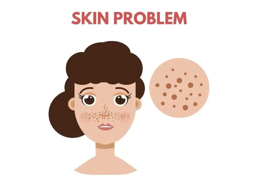 褐青斑是什么原因形成的,褐青色斑产生的原因