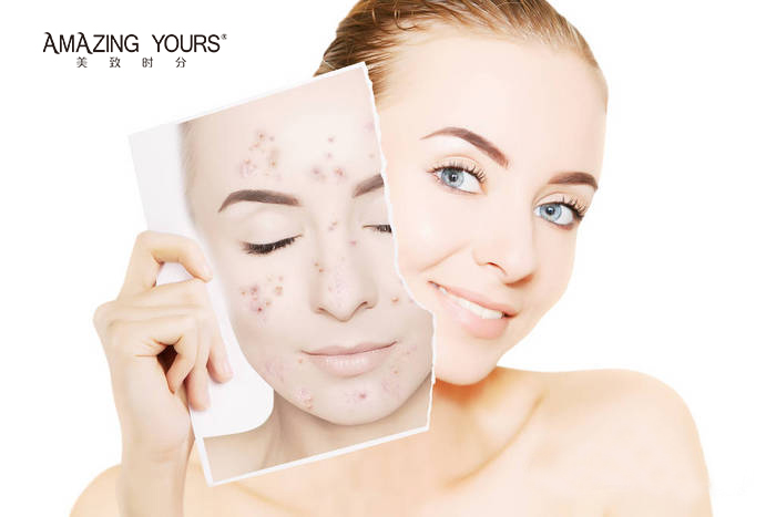 体内热脸上长痘是什么原因引起的,四十岁脸上总是长痘是什么原因呢