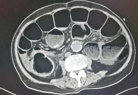 肚子天天咕咕响是肠癌的前兆吗,肚子老是咕噜咕噜响是肠癌表现吗