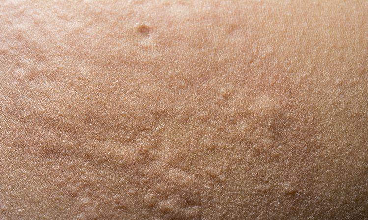 花椒煮水对荨麻疹有疗效吗,苎麻煮水喝可以治荨麻疹吗