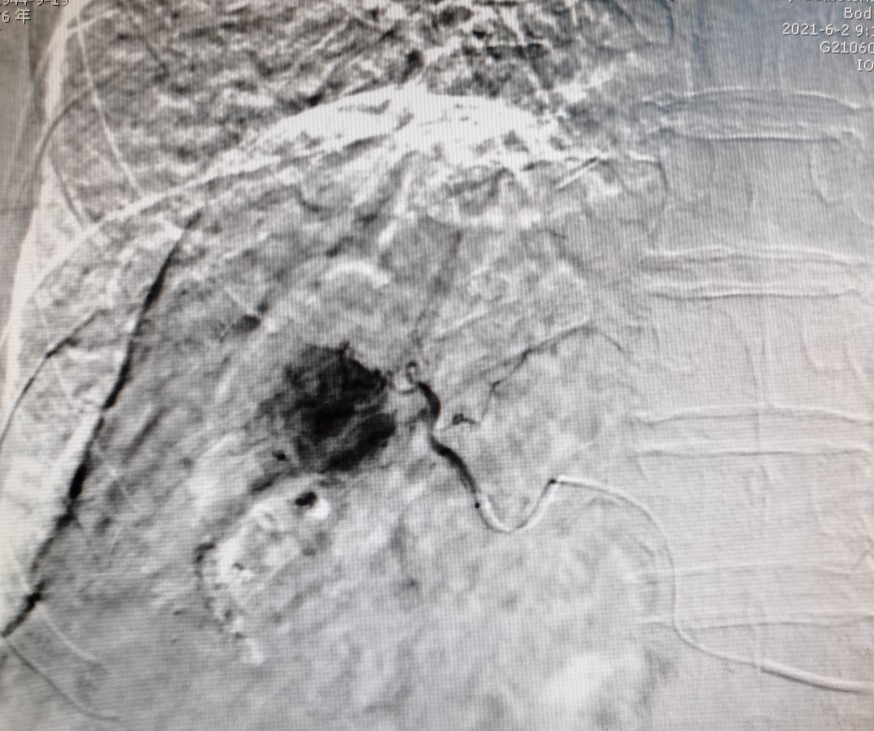 黄婶的肝癌用介入治疗已经3年多了-适合自己的治疗才是最好的治疗