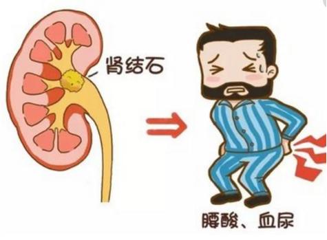 做完体外碎石为什么总大便,体外碎石后出现结石的原因