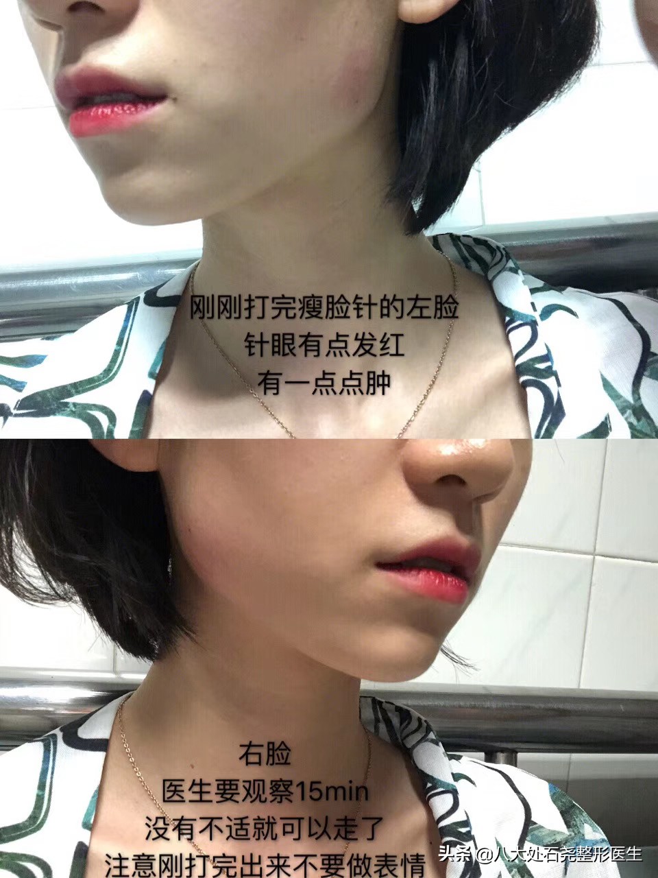 瘦脸针后苹果肌下垂凹陷能恢复吗,你有脸部下垂的烦恼吗