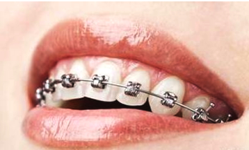 戴牙套戴哪种牙套最好,金属牙套与陶瓷牙套的优缺点