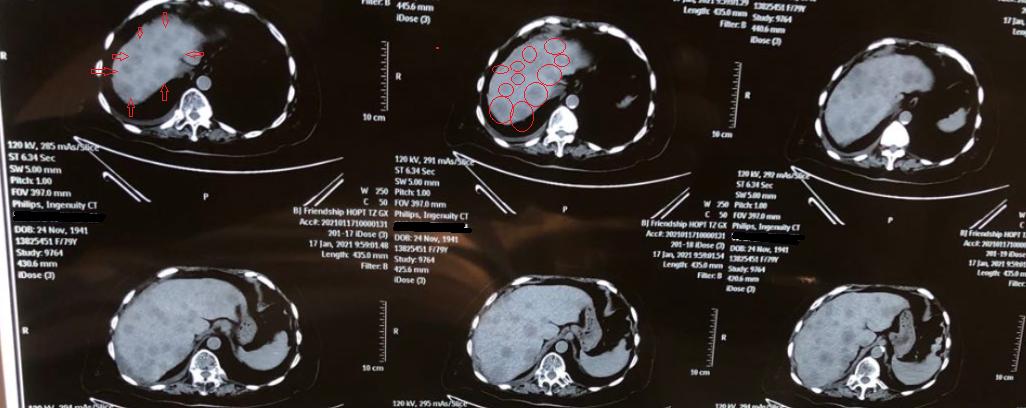 什么癌容易转移到淋巴结,什么癌最容易转移到脑部