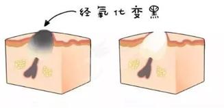 爆痘闭口做什么项目,爆闭口怎么办