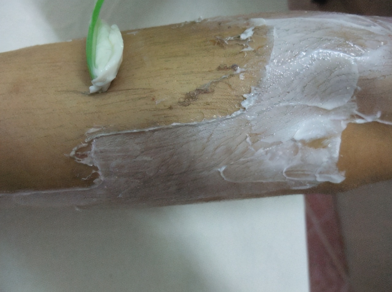 毛发脱毛,哪种脱毛才是永久性脱毛