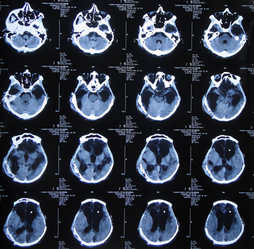 脑受伤开颅手术昏迷,开颅手术后20天发生脑积水引流