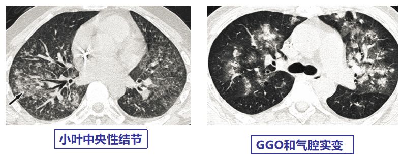 专家讲新冠二次感染的情况讲解,感染新冠专家怎么说