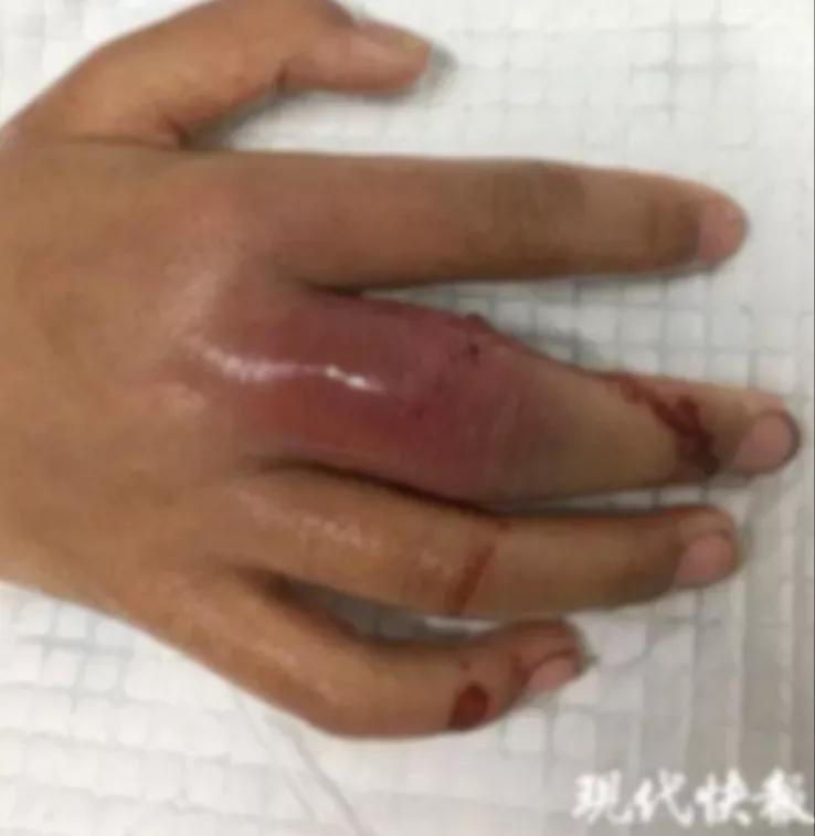 与它“握”了个手,男子手指红肿溃烂!医生:别大意