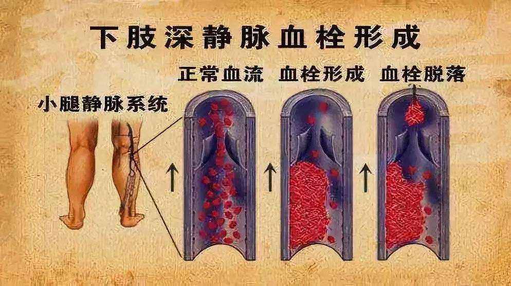 预防血栓最有效的方法阿司匹林,孕期预防血栓如何打肝素