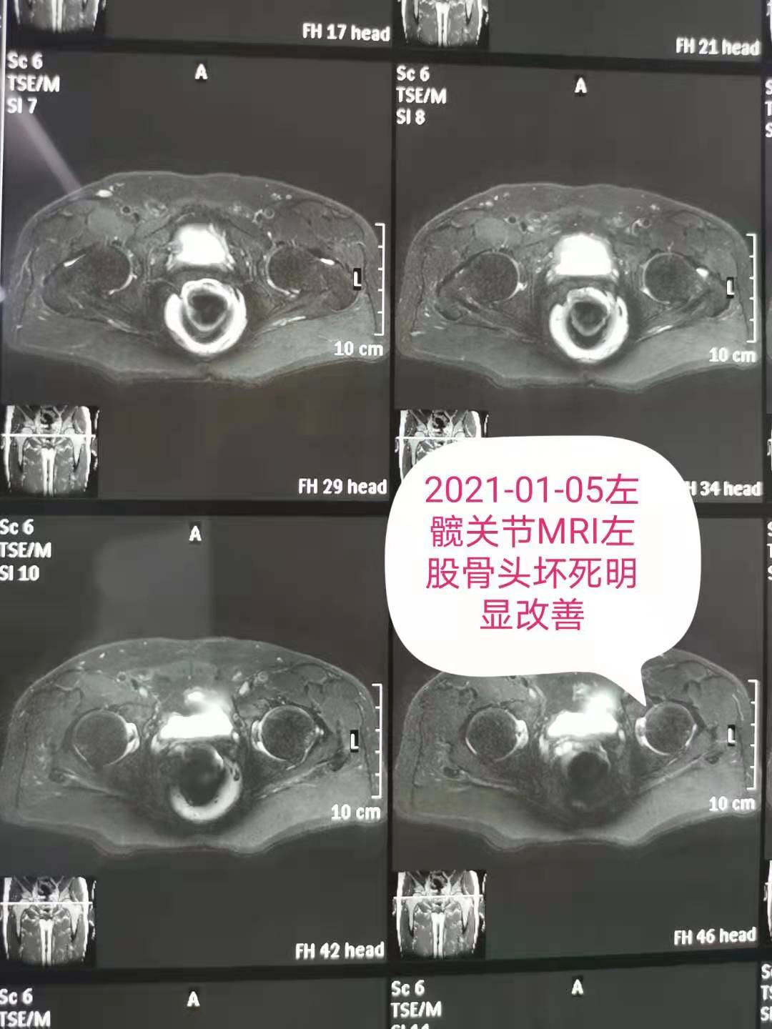 久久为功！水矿总医院以冲击波为主治疗一例股骨头坏死病例效果不错