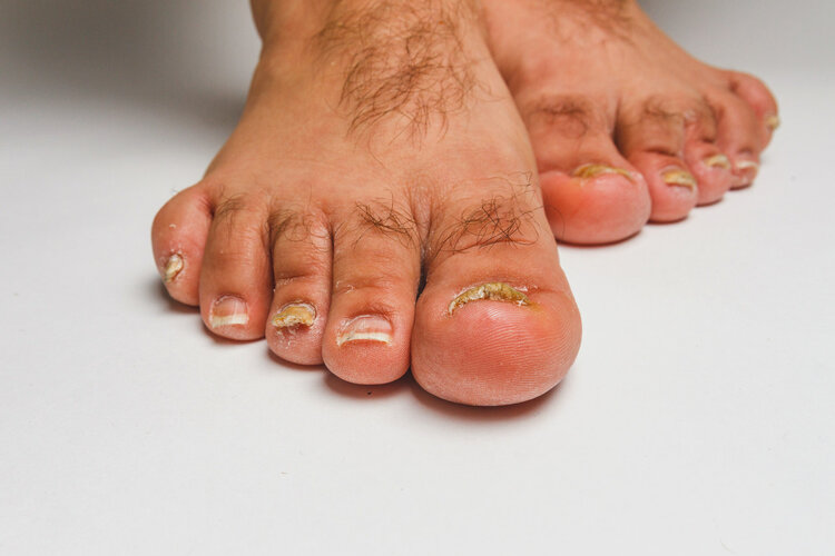 脚趾甲甲根处嵌甲怎么治疗,脚趾甲老往肉里长是缺什么吗