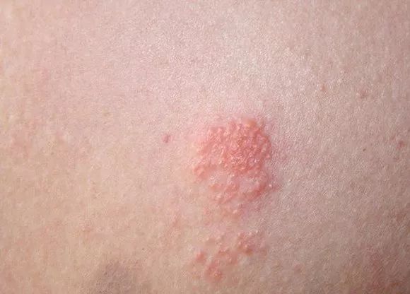 有一种剧痛叫带状疱疹,肋间神经痛与带状疱疹哪个比较痛