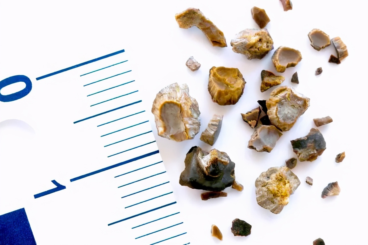 输尿管堵塞引起肾积水还能喝水吗,为什么喝水可以排出结石