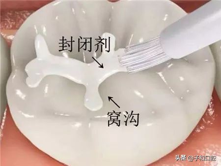 孩子牙齿都烂没了影响换牙吗,孩子牙齿坏了觉得自己不配做父母