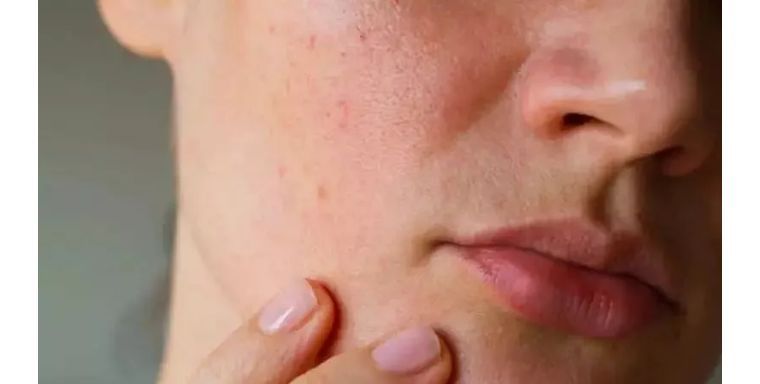 如何避免频繁戴口罩引起皮肤问题,戴口罩后护肤注意什么