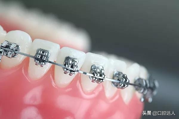 刚戴上牙套感觉酸疼，是怎么回事？